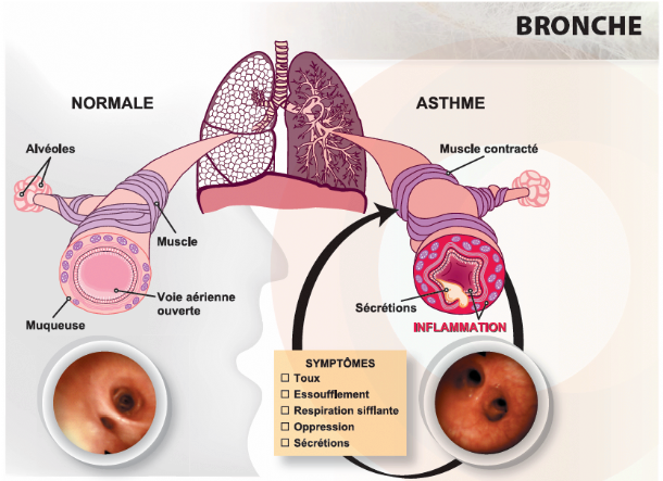 bronche-asthme.png bronche-asthme.png